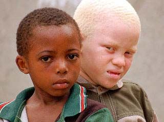 негр альбинос