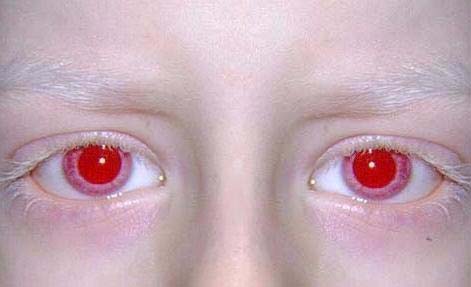 красные глаза альбиноса