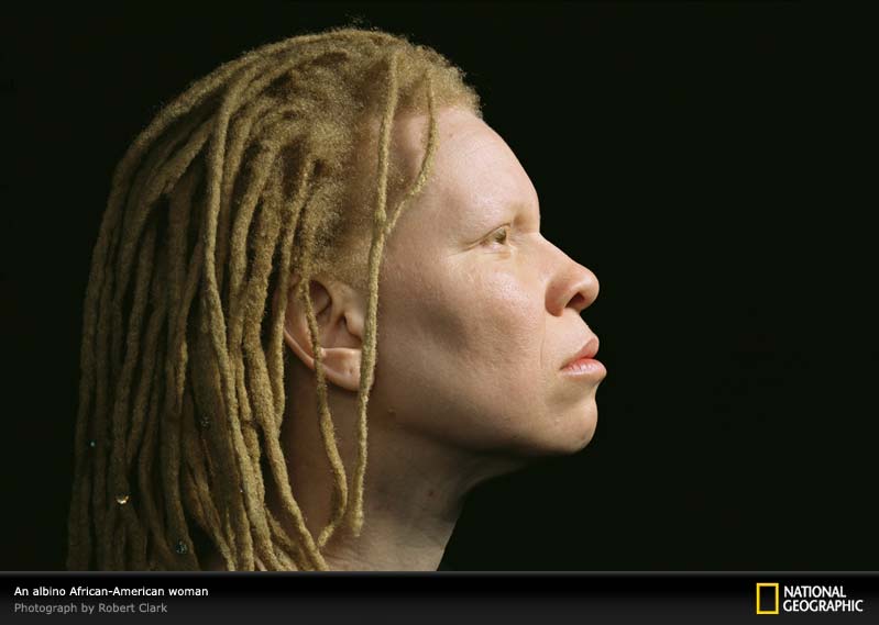 негритянка альбинос